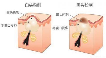 牙膏去黑头有用吗 用牙膏去黑头有什么害处